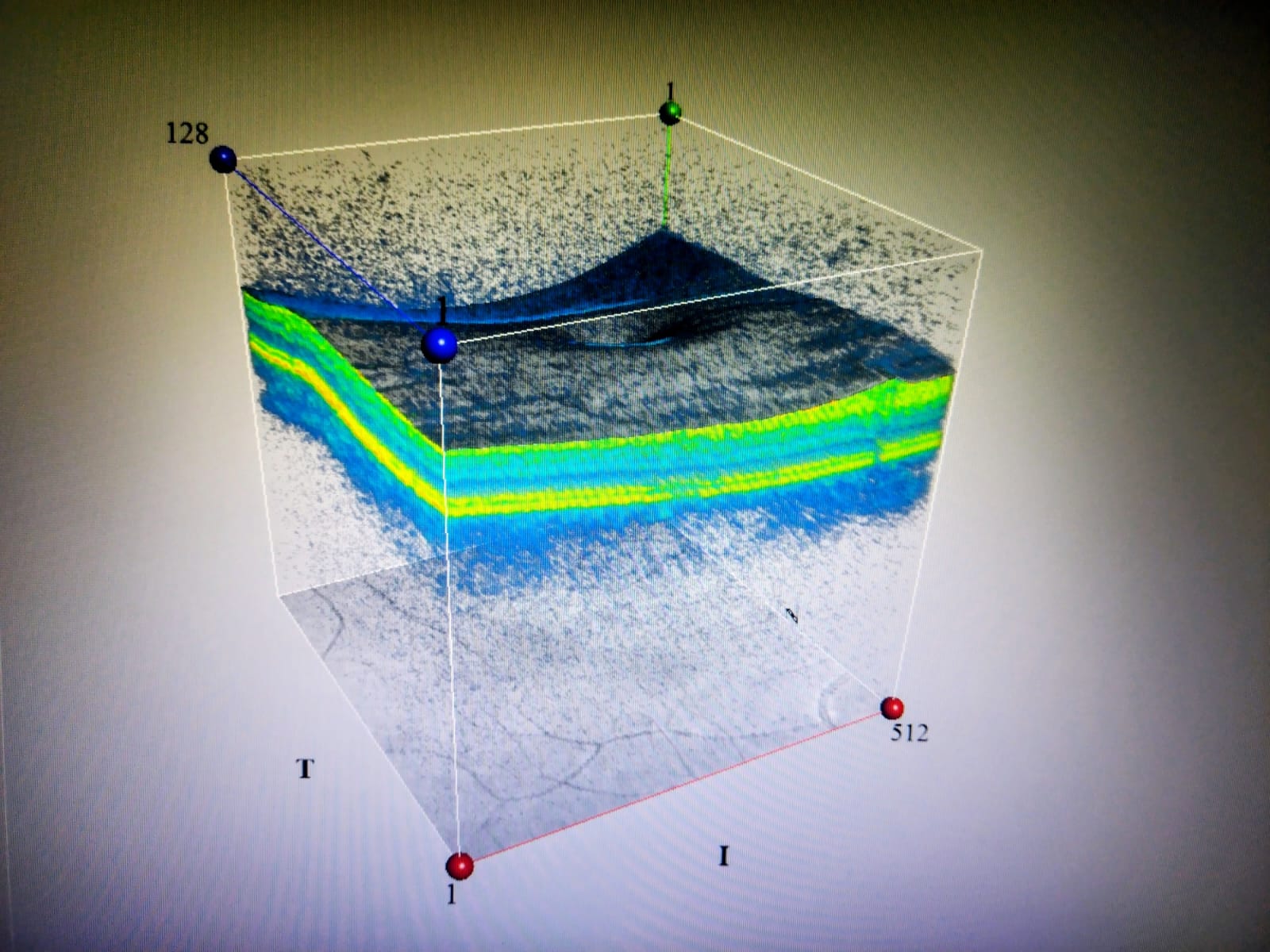 Imagen de Cubo macular en OCT