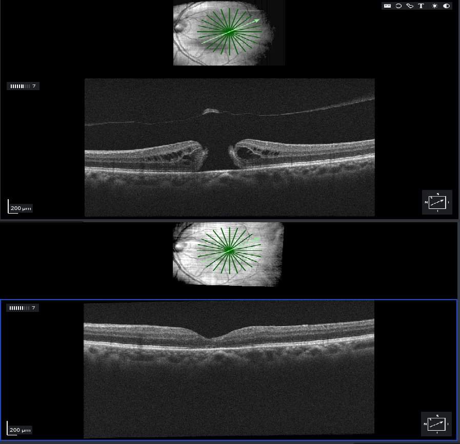 Imagen de Cirugía de agujero macular