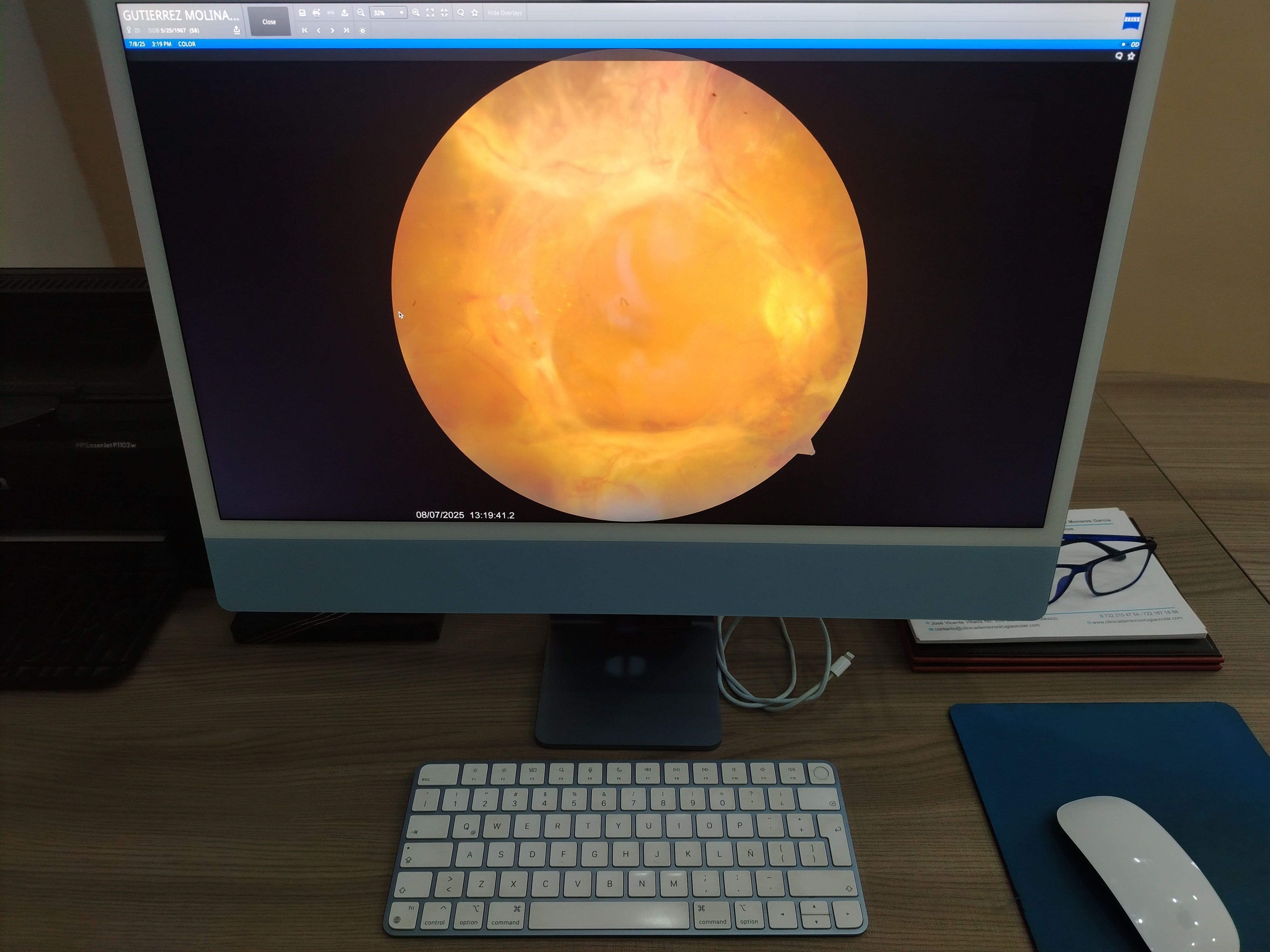 Imagen de Visualizando el desprendimiento de retina traccional en un paciente con retinopatía diabética muy avanzada