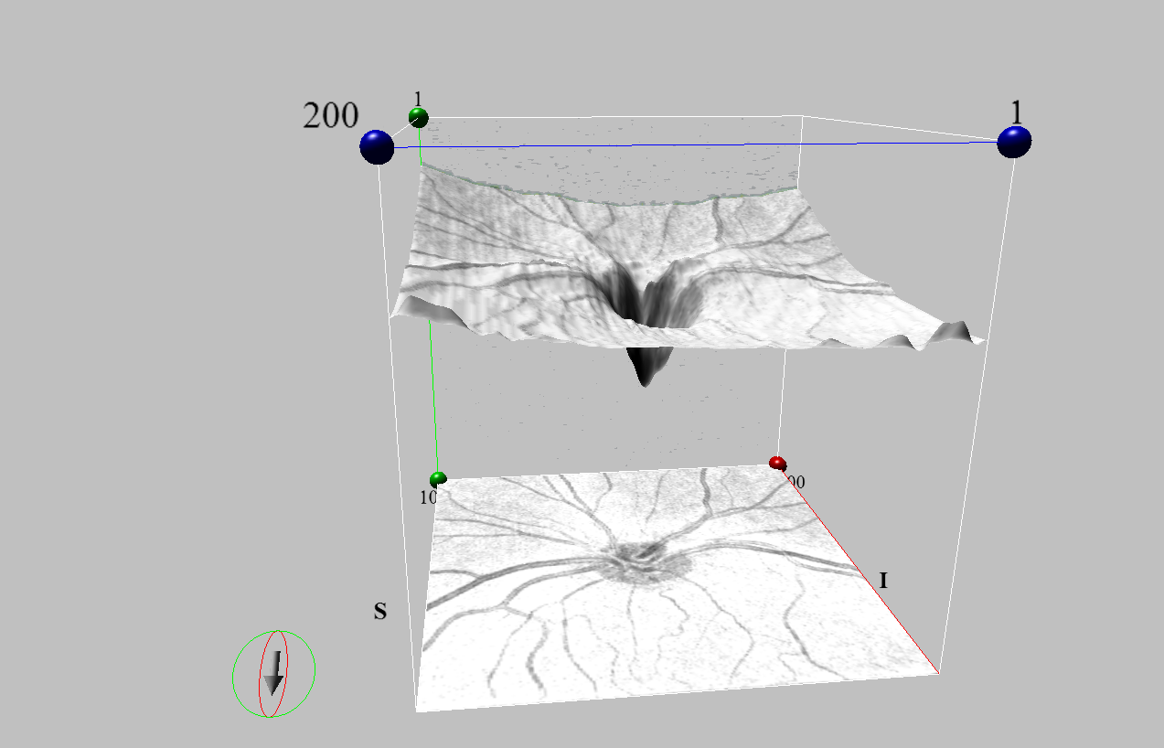 Imagen de Nervio óptico normal en 3D con OCT-Angio