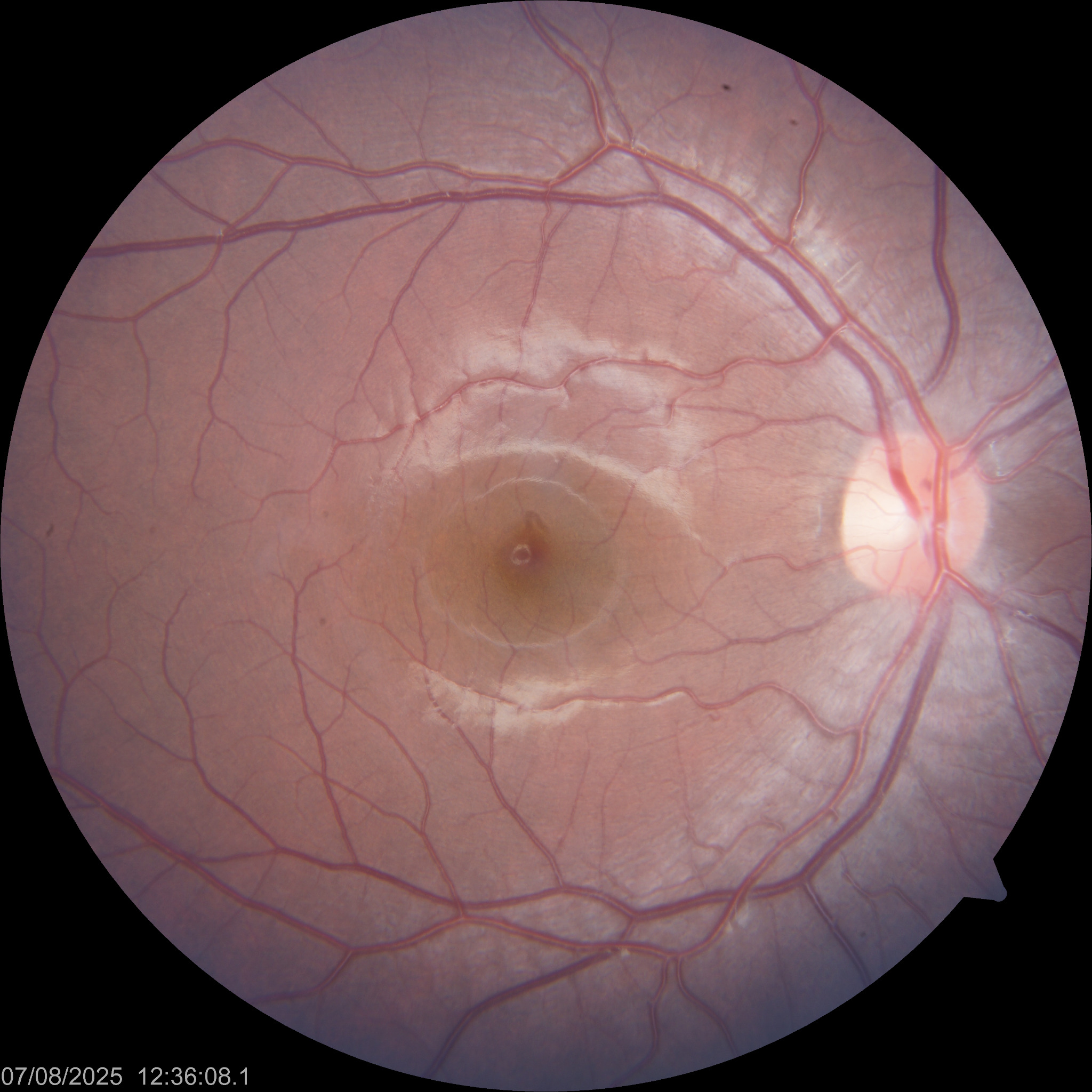 Imagen de ¿Cómo describe un retinólogo una retina normal?