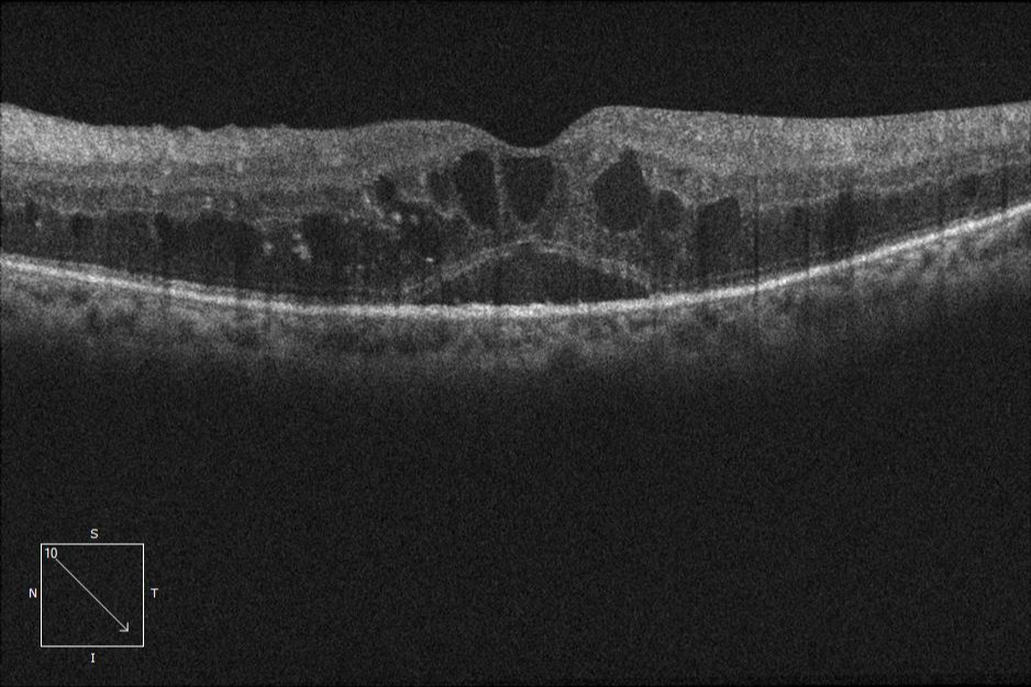Imagen de Edema macular quístico y desprendimiento del epitelio pigmentario en OCT